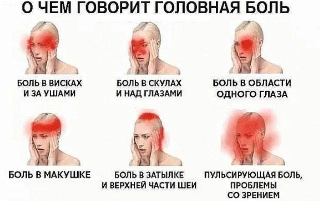 Боль во лбу. Схема локализации головной боли. Причины головной боли. Боль в висках. Головная боль части головы.