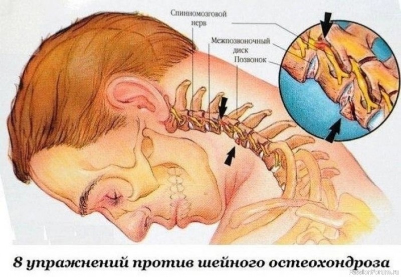 Упражнения против шейного остеохондроза